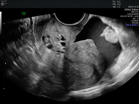 cul fill|minimal posterior cul de sac fluid.